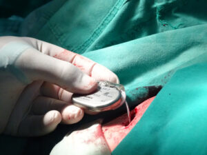 Blockierte Herzen: Warten auf einen Impuls 1 herzschrittmacher camagueey